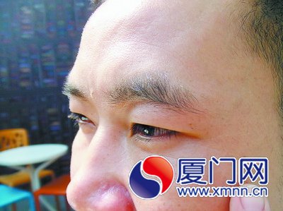 梁先生認(rèn)為，打針后，他眼睛下的皺紋并未減少。