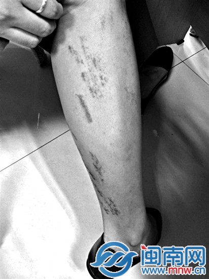黃小姐小腿前后均有類似的血痕