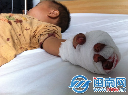 小園的左手無名指被三輪電動車鏈條絞斷