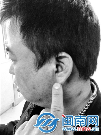 雷師傅經(jīng)檢查，為左耳膜開(kāi)放性損傷